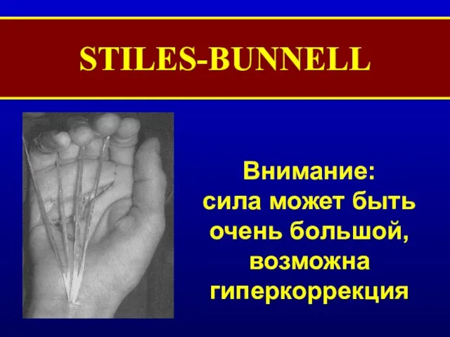 STILES-BUNNELL Внимание: сила может быть очень большой, возможна гиперкоррекция