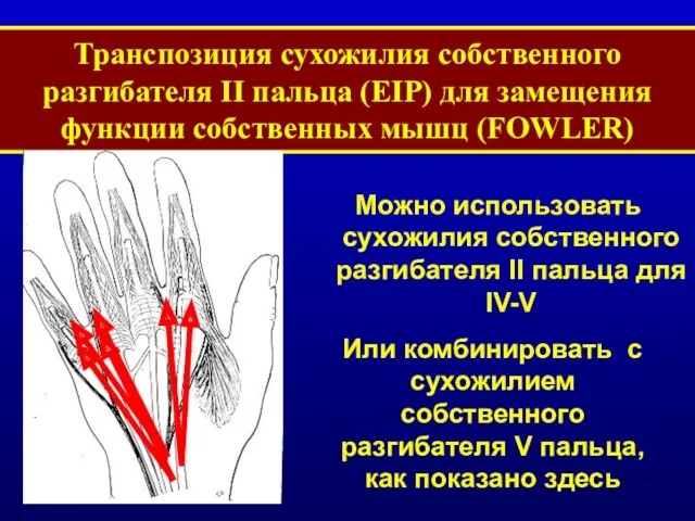 Транспозиция сухожилия собственного разгибателя II пальца (EIP) для замещения функции