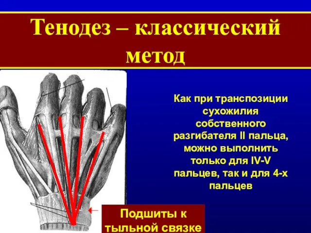 Тенодез – классический метод