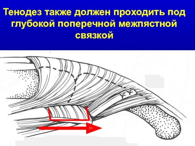 Тенодез также должен проходить под глубокой поперечной межпястной связкой