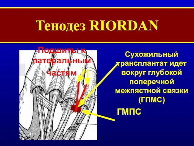 Тенодез RIORDAN