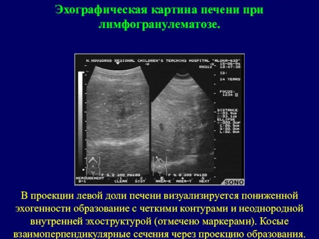 В проекции левой доли печени визуализируется пониженной эхогенности образование с