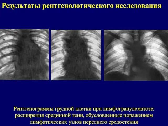 Результаты рентгенологического исследования Рентгенограммы грудной клетки при лимфогранулематозе: расширения срединной