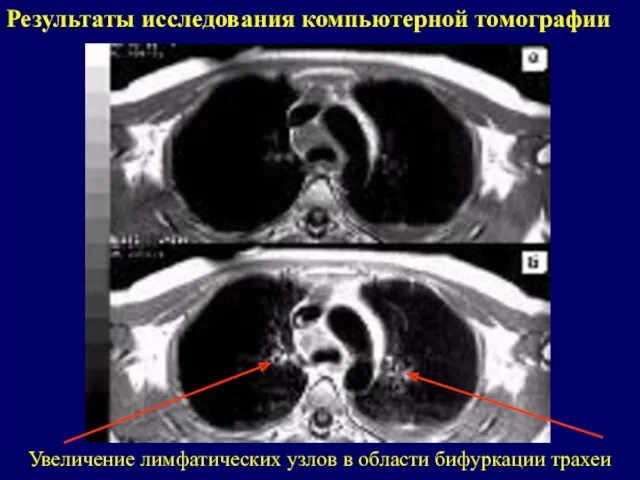 Результаты исследования компьютерной томографии Увеличение лимфатических узлов в области бифуркации трахеи