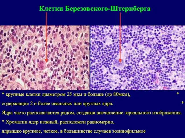 Клетки Березовского-Штернберга * крупные клетки диаметром 25 мкм и больше