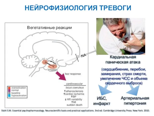 НЕЙРОФИЗИОЛОГИЯ ТРЕВОГИ Кардиальная паническая атака NA ИБС, инфаркт (сердцебиение, перебои,