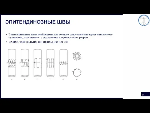 ЭПИТЕНДИНОЗНЫЕ ШВЫ Эпитендинозные швы необходимы для точного сопоставления краев сшиваемого