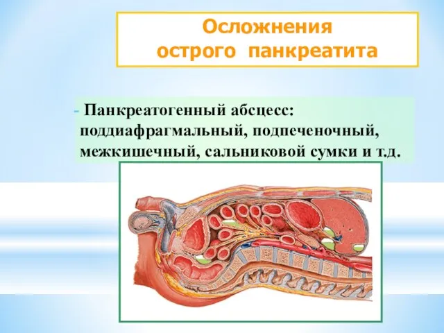 Осложнения острого панкреатита Панкреатогенный абсцесс: поддиафрагмальный, подпеченочный, межкишечный, сальниковой сумки и т.д.