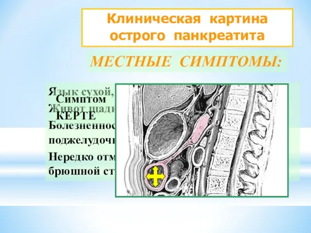 Клиническая картина острого панкреатита МЕСТНЫЕ СИМПТОМЫ: Язык сухой, обложен налетом. Живот щадится при