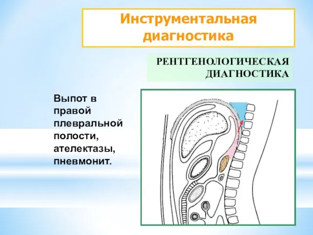 Инструментальная диагностика РЕНТГЕНОЛОГИЧЕСКАЯ ДИАГНОСТИКА Выпот в правой плевральной полости, ателектазы, пневмонит.