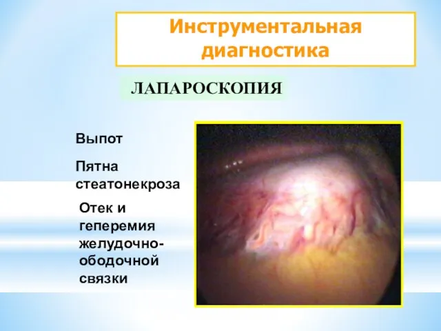 Инструментальная диагностика ЛАПАРОСКОПИЯ Выпот Пятна стеатонекроза Отек и геперемия желудочно-ободочной связки