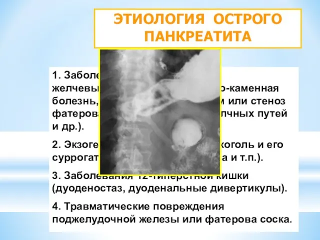 ЭТИОЛОГИЯ ОСТРОГО ПАНКРЕАТИТА 1. Заболевания внепеченочных желчевыводящих путей (желчно-каменная болезнь, холедохолитиаз, спазм или