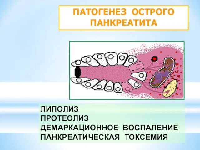 ПАТОГЕНЕЗ ОСТРОГО ПАНКРЕАТИТА ЛИПОЛИЗ ПРОТЕОЛИЗ ДЕМАРКАЦИОННОЕ ВОСПАЛЕНИЕ ПАНКРЕАТИЧЕСКАЯ ТОКСЕМИЯ