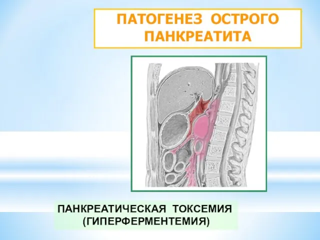 ПАТОГЕНЕЗ ОСТРОГО ПАНКРЕАТИТА ПАНКРЕАТИЧЕСКАЯ ТОКСЕМИЯ (ГИПЕРФЕРМЕНТЕМИЯ)