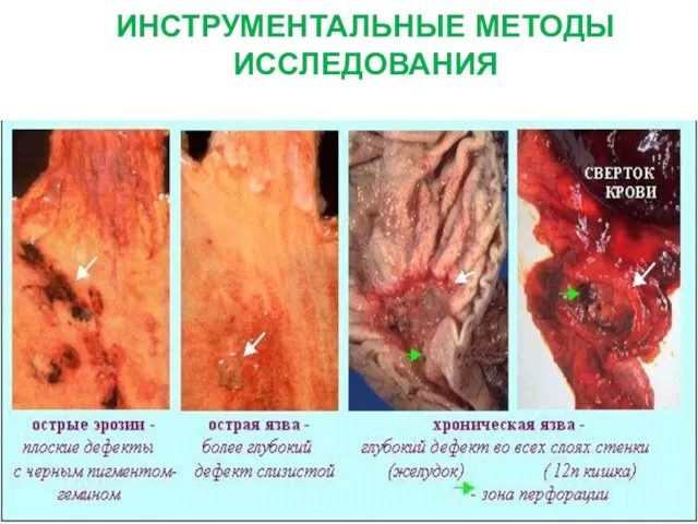 ЛАБОРАТОРНЫЕ И ИНСТРУМЕНТАЛЬНЫЕ МЕТОДЫ ИССЛЕДОВАНИЯ Фиброгастродуоденоскопия (ФГДС )