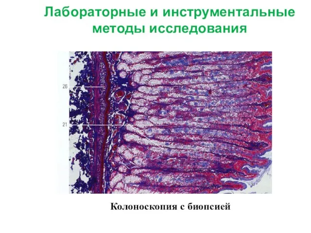 Лабораторные и инструментальные методы исследования Колоноскопия с биопсией