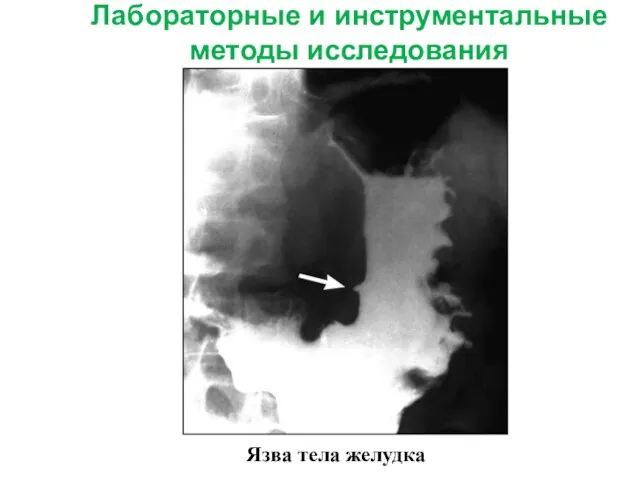 Лабораторные и инструментальные методы исследования Язва тела желудка