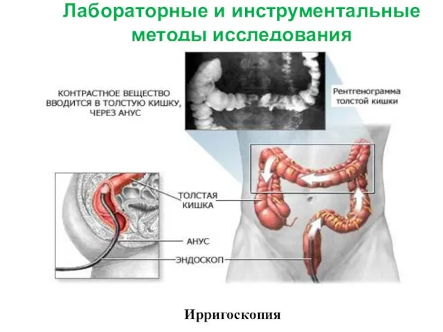 Лабораторные и инструментальные методы исследования Ирригоскопия