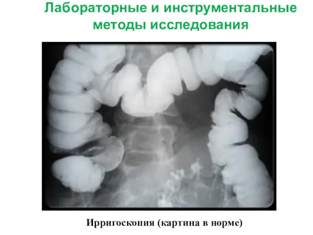 Лабораторные и инструментальные методы исследования Ирригоскопия (картина в норме)