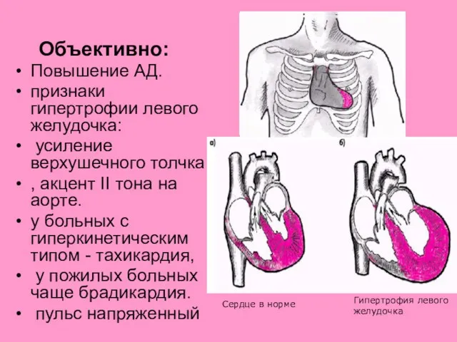 Повышение АД. признаки гипертрофии левого желудочка: усиление верхушечного толчка ,