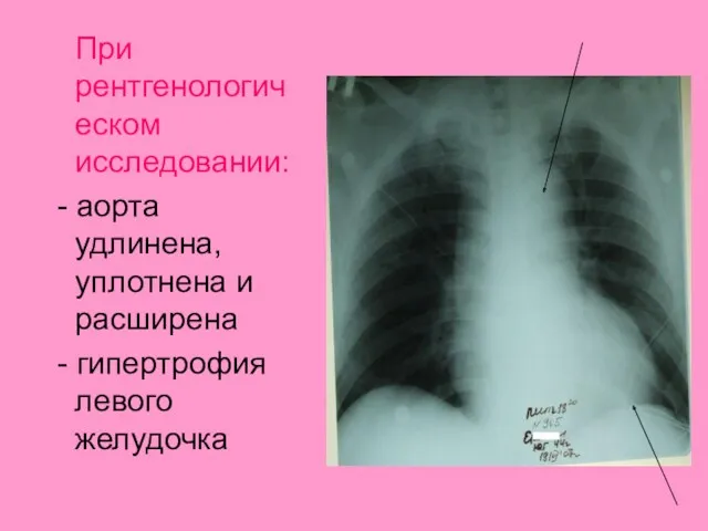 При рентгенологическом исследовании: - аорта удлинена, уплотнена и расширена - гипертрофия левого желудочка