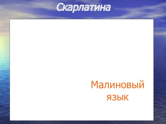 Скарлатина Малиновый язык