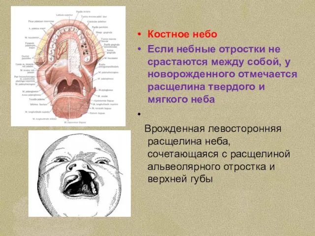 Костное небо Если небные отростки не срастаются между собой, у