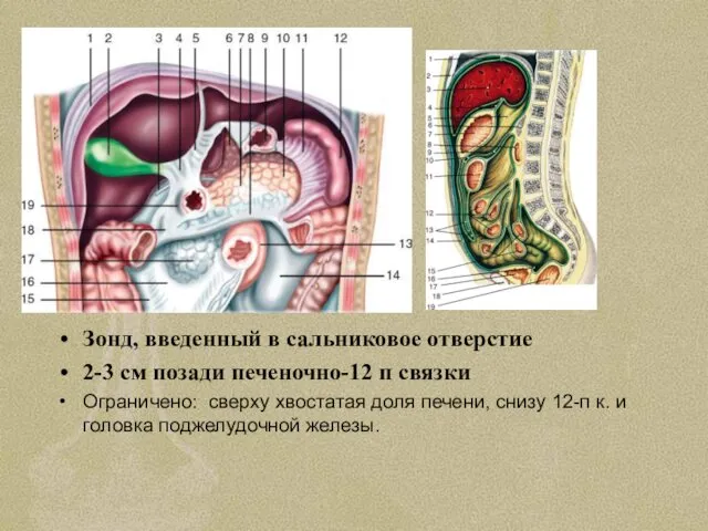 Зонд, введенный в сальниковое отверстие 2-3 см позади печеночно-12 п