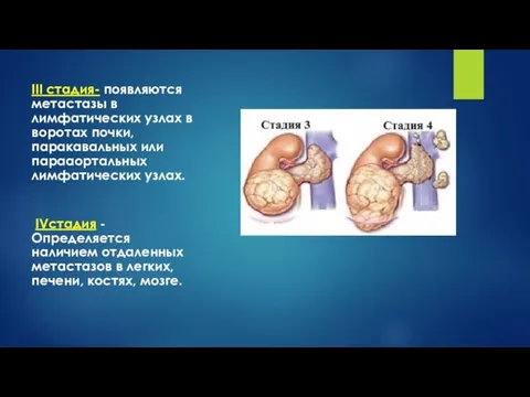 III стадия- появляются метастазы в лимфатических узлах в воротах почки,
