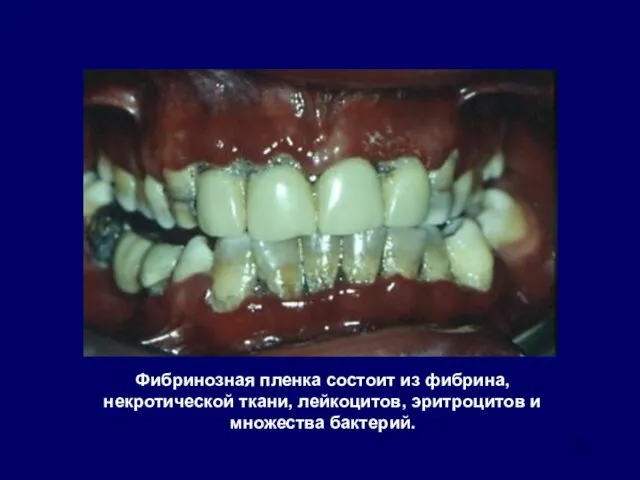 Фибринозная пленка состоит из фибрина, некротической ткани, лейкоцитов, эритроцитов и множества бактерий.