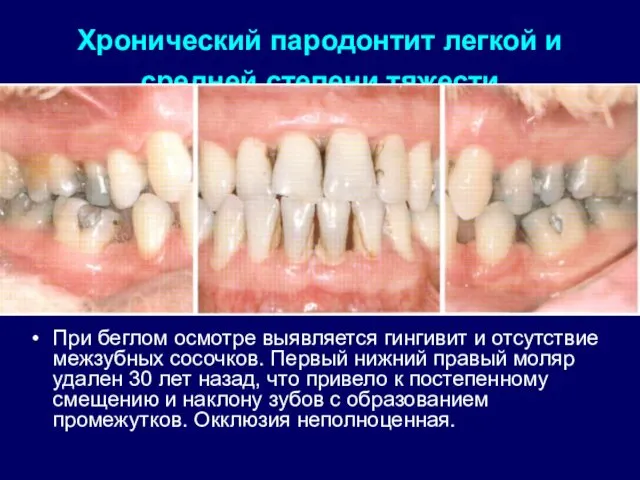 Хронический пародонтит легкой и средней степени тяжести При беглом осмотре