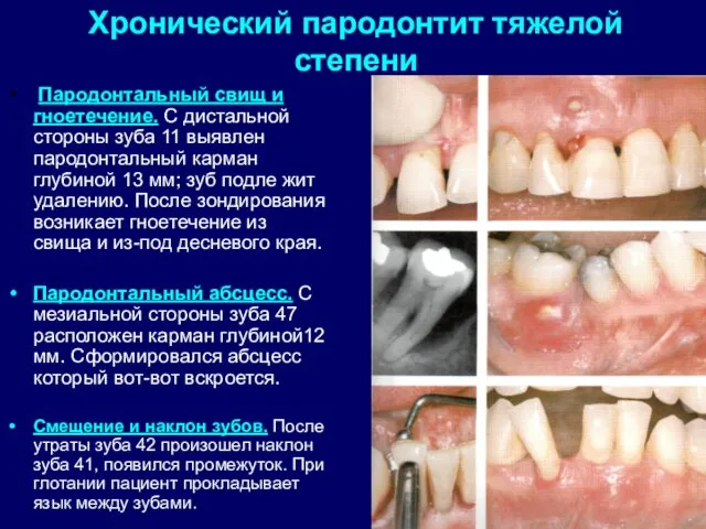 Хронический пародонтит тяжелой степени Пародонтальный свищ и гноетечение. С дистальной