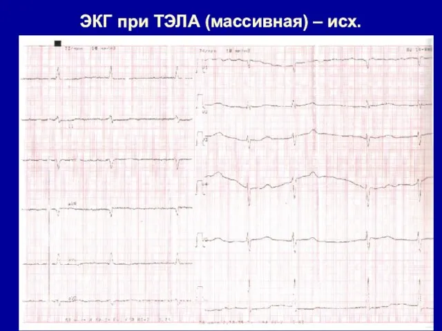 ЭКГ при ТЭЛА (массивная) – исх.