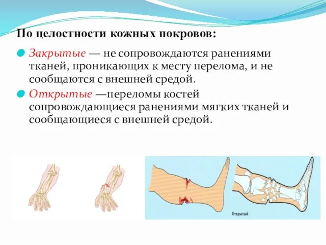 По целостности кожных покровов: Закрытые — не сопровождаются ранениями тканей, проникающих к месту