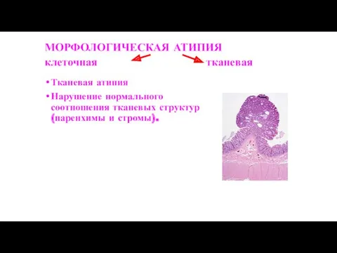 МОРФОЛОГИЧЕСКАЯ АТИПИЯ клеточная тканевая Тканевая атипия Нарушение нормального соотношения тканевых структур (паренхимы и стромы).