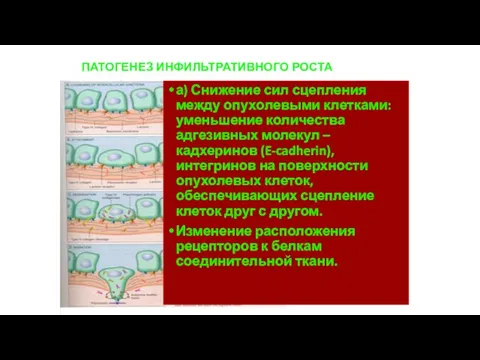 ПАТОГЕНЕЗ ИНФИЛЬТРАТИВНОГО РОСТА а) Снижение сил сцепления между опухолевыми клетками: