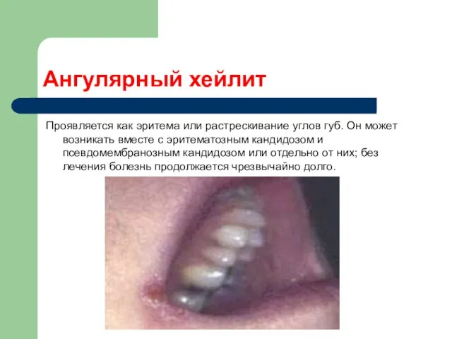 Ангулярный хейлит Проявляется как эритема или растрескивание углов губ. Он может возникать вместе
