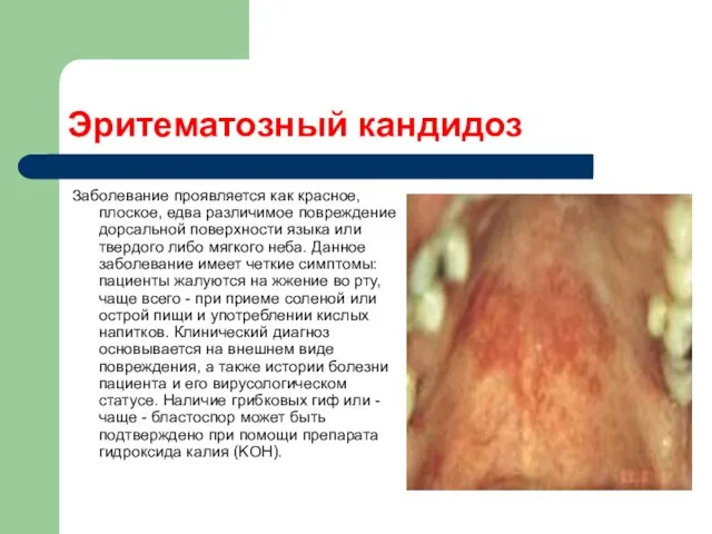 Эритематозный кандидоз Заболевание проявляется как красное, плоское, едва различимое повреждение дорсальной поверхности языка