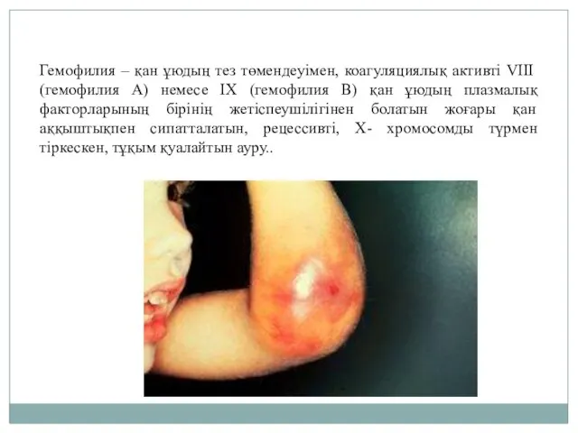 Гемофилия – қан ұюдың тез төмендеуімен, коагуляциялық активті VIII (гемофилия А) немесе IX