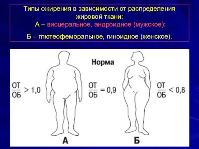 Типы ожирения в зависимости от распределения жировой ткани: А – висцеральное, андроидное (мужское);