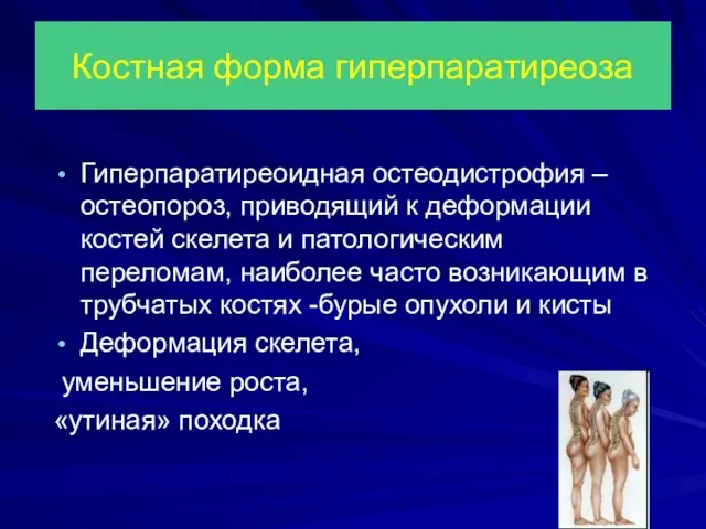 Костная форма гиперпаратиреоза Гиперпаратиреоидная остеодистрофия – остеопороз, приводящий к деформации