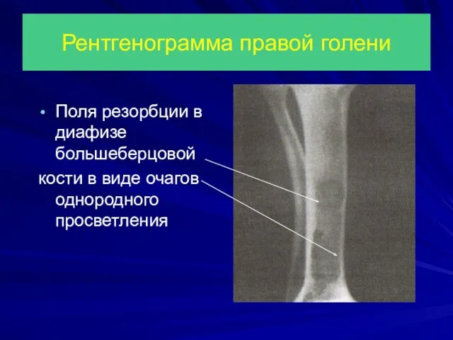 Рентгенограмма правой голени Поля резорбции в диафизе большеберцовой кости в виде очагов однородного просветления