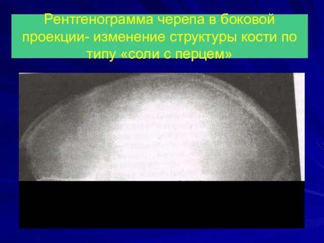 Рентгенограмма черепа в боковой проекции- изменение структуры кости по типу «соли с перцем»