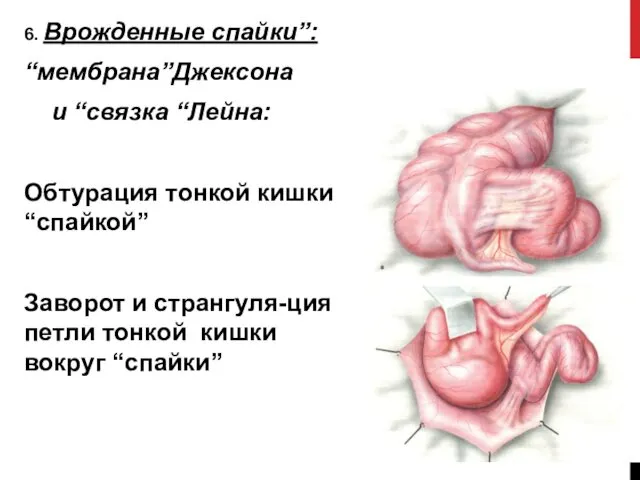 6. Врожденные спайки”: “мембрана”Джексона и “связка “Лейна: Обтурация тонкой кишки