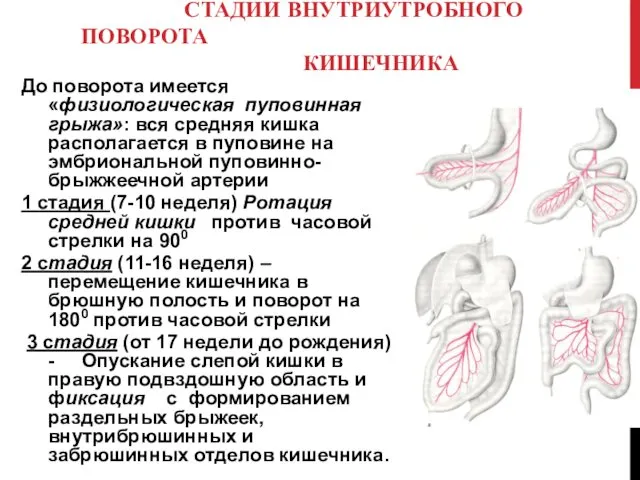 СТАДИИ ВНУТРИУТРОБНОГО ПОВОРОТА КИШЕЧНИКА До поворота имеется «физиологическая пуповинная грыжа»: