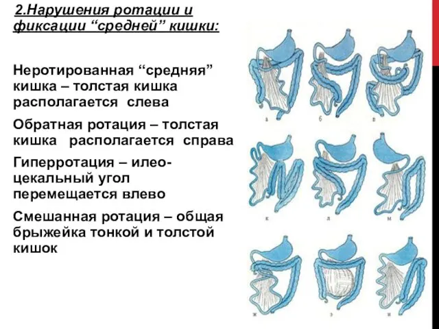 2.Нарушения ротации и фиксации “средней” кишки: Неротированная “средняя” кишка –