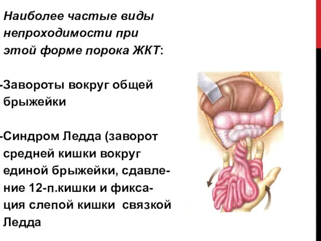 Наиболее частые виды непроходимости при этой форме порока ЖКТ: Завороты