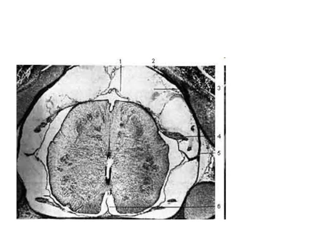 1 - pia mater; 2 - dura mater и arachnoides;