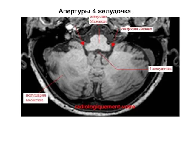 Апертуры 4 желудочка: