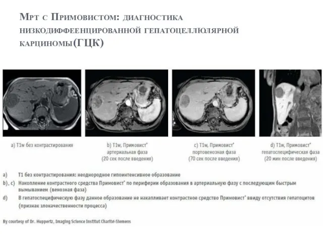 Мрт с Примовистом: диагностика низкодиффеенцированной гепатоцеллюлярной карциномы(ГЦК)